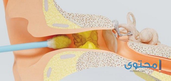 طريقة تنظيف الأذن المسدودة في المنزل
