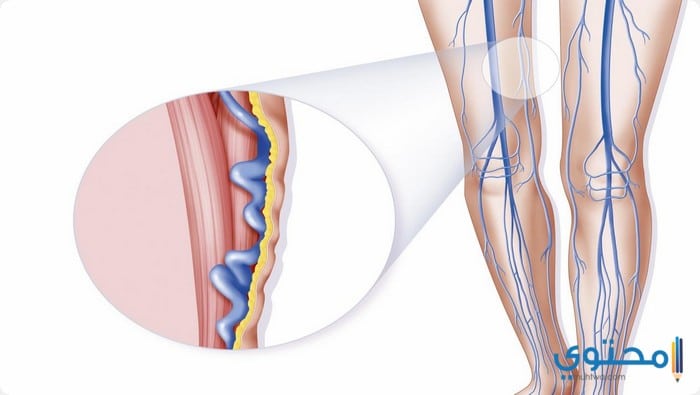 أسباب وأعراض دوالي القدمين وطرق العلاج