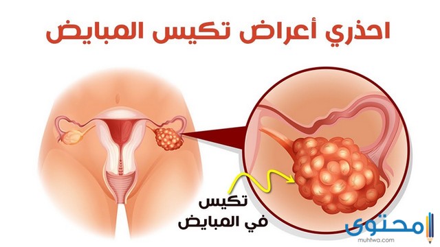 أعراض تكيس المبايض للمتزوجات