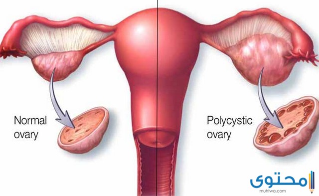 أعراض تكيس المبايض