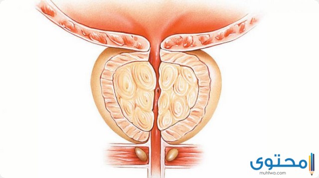 أعراض سرطان البروستاتا