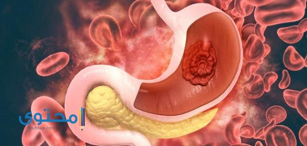 أعراض سرطان المعدة : الأسباب وطرق العلاج