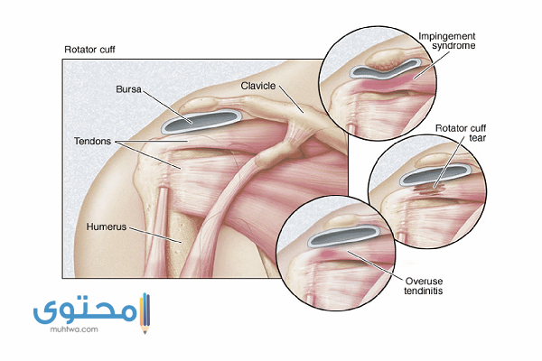 ألم في الكتف الأيسر من الخلف والأمام