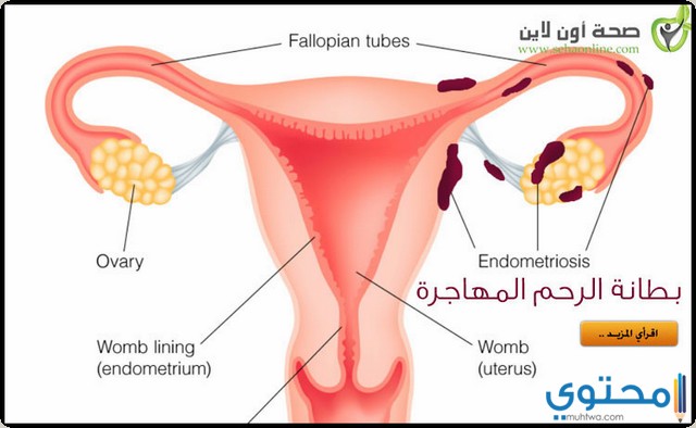 ادوية علاج بطانة الرحم المهاجرة