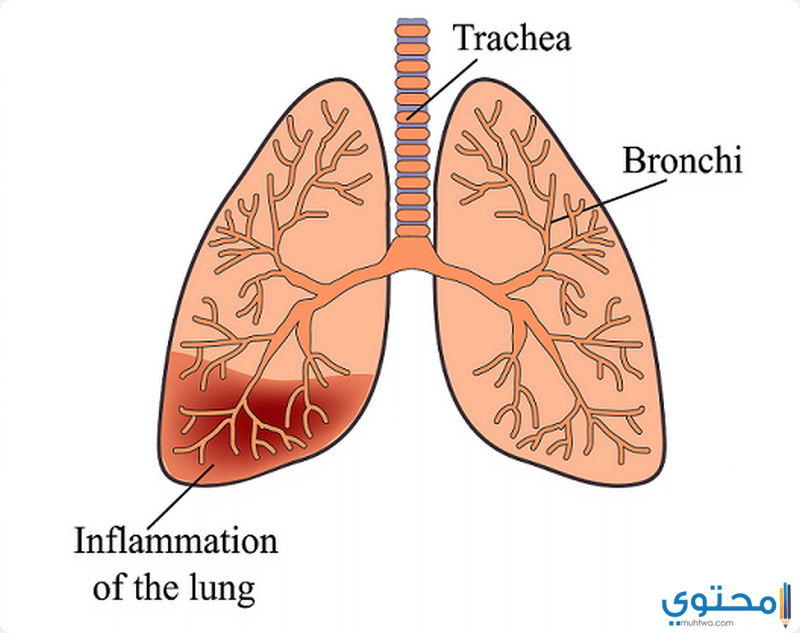 طرق علاج مرض الالتهاب الرئوي