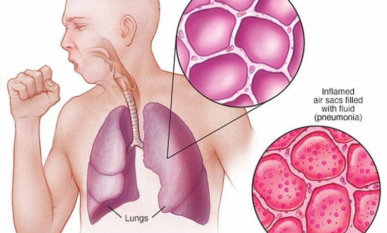 طرق علاج الالتهاب الرئوي والوقاية منه