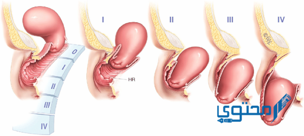 تجربتي مع نزول الرحم وعلاجه بالاعشاب