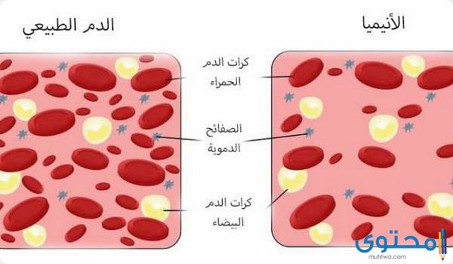 تحليل ferritin