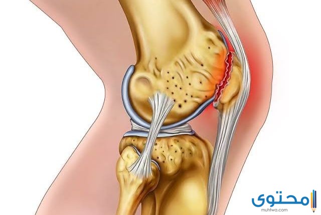 تورم الركبة