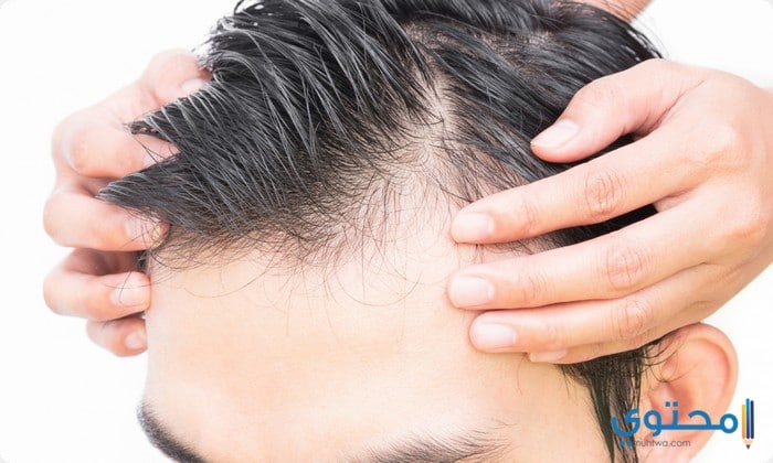 أسعار زراعة الشعر