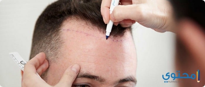 مراكز زراعة الشعر فى الجزائر