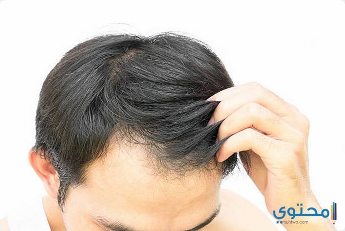 عيادات ومراكز زراعة الشعر في دبي