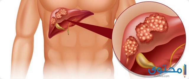 أعراض سرطان الكبد