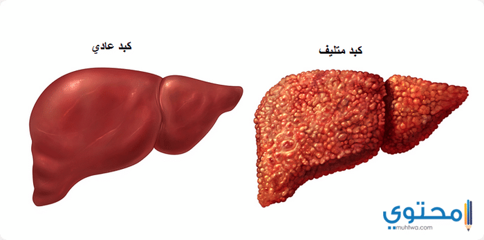 علاج التهاب الكبد بالأعشاب