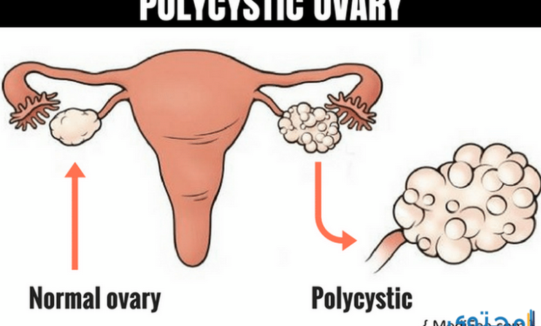 طرق علاج تكيس المبايض للمتزوجة وعند البنات