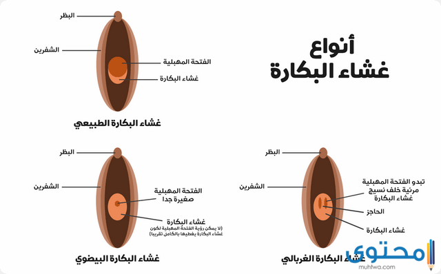 غشاء البكارة