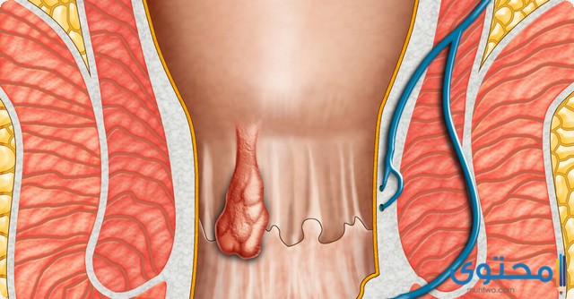 كيف تختفي البواسير الخارجية