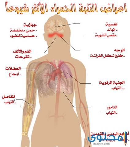 الذئبة الحمراء