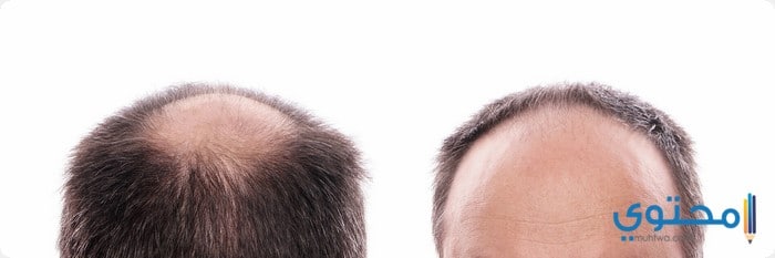 نجاح عمليات زراعة الشعر