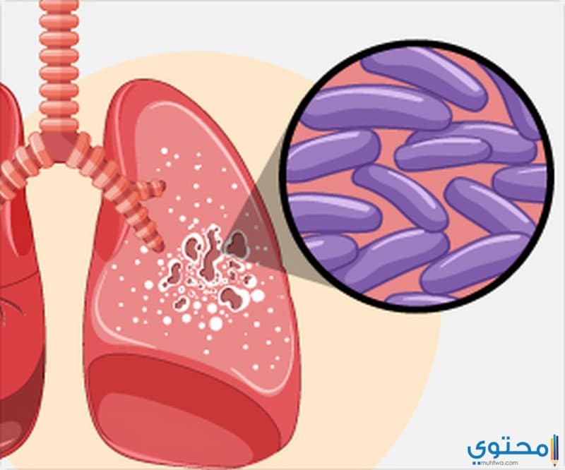 أعراض مرض الدرن