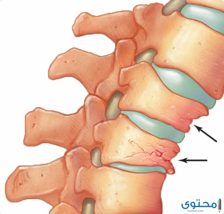 اذاعة مدرسية عن هشاشة العظام