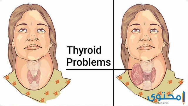 هل الغدة الدرقية تسبب ألم في الحنجرة