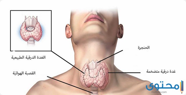 هل الغدة الدرقية تسبب ألم في الحنجرة